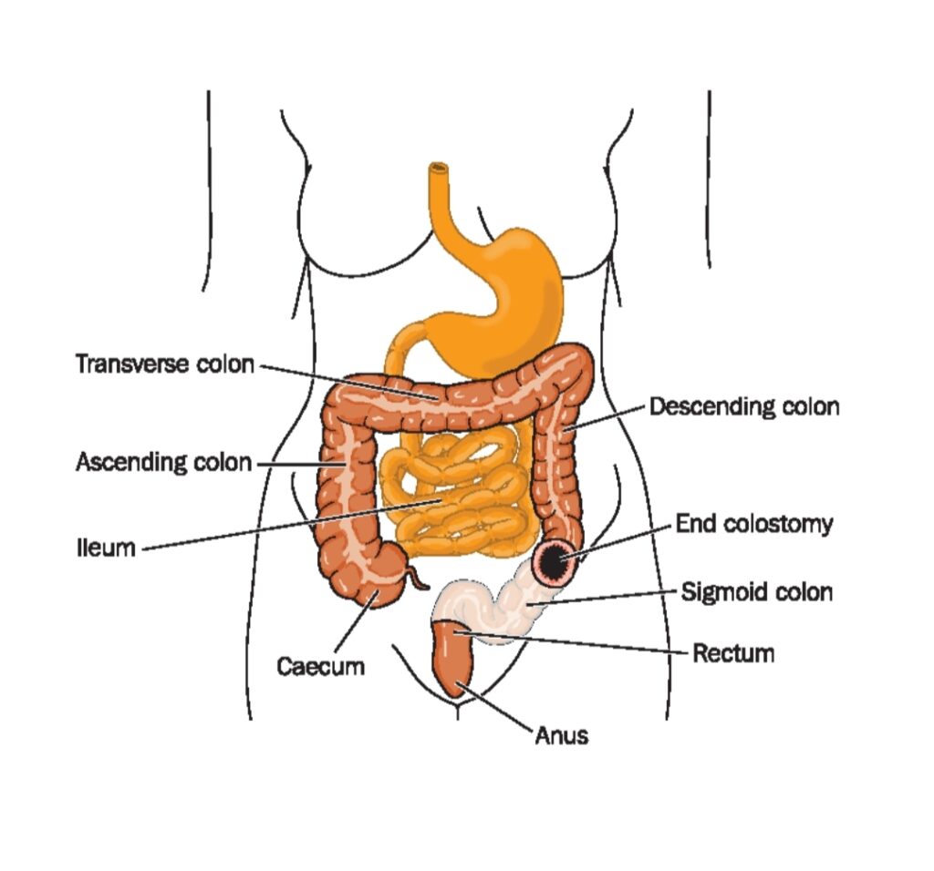 Colostomy